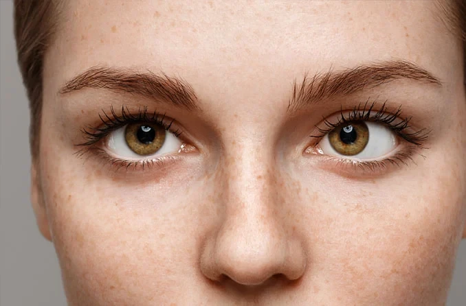 Squint Surgery